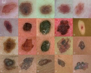 skin cancer