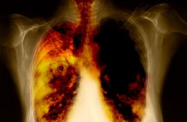 Lung Cancer