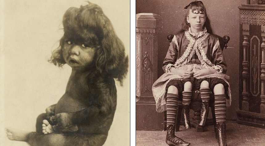 26-month-old hairy baby and 4 legged girl Circus Performers at 19th Century in New York (Photo)