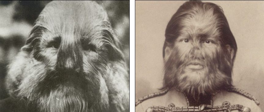 Lion faced Boy and Dog faced Boy Circus Performers at 19th Century in New York (Photo)