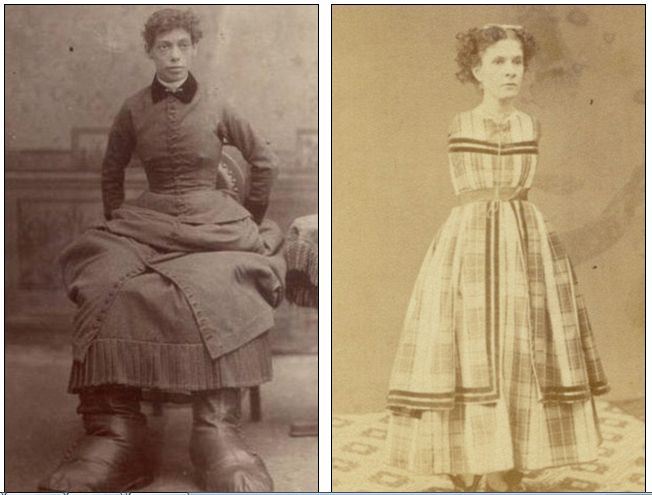 Big Foot and Armless Circus Performers at 19th Century in New York (Photo)
